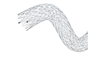 Inspire MD CGuard carotid stent 6.00 x 30 mm